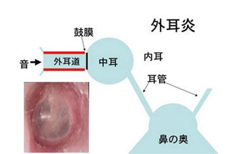 耳熱|耳の病気